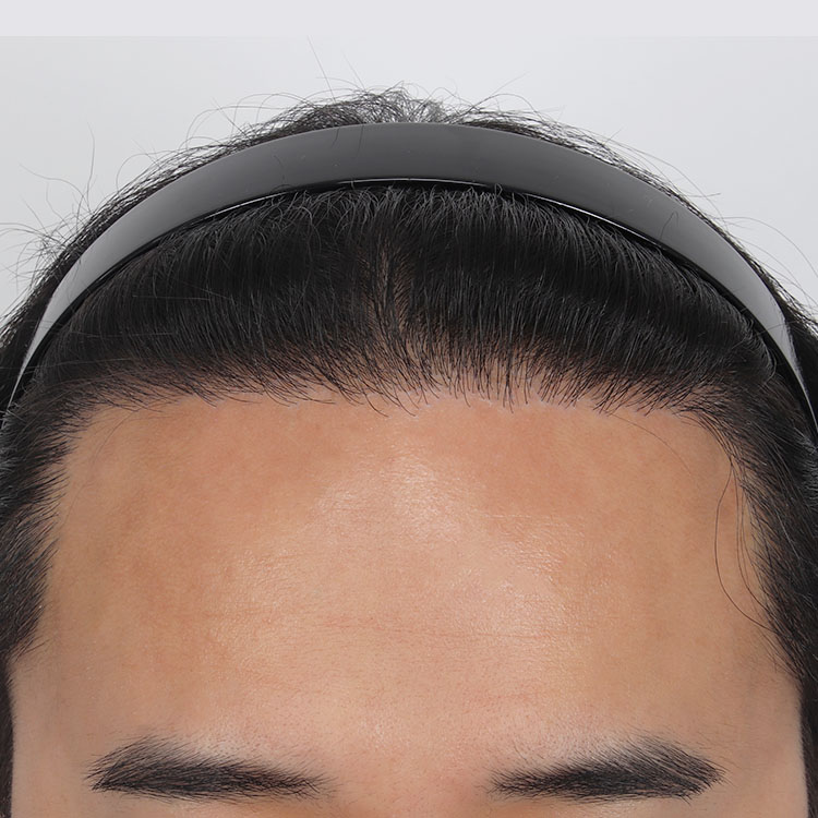 치료 후